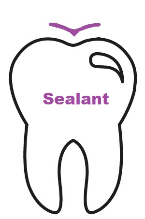 Sealant